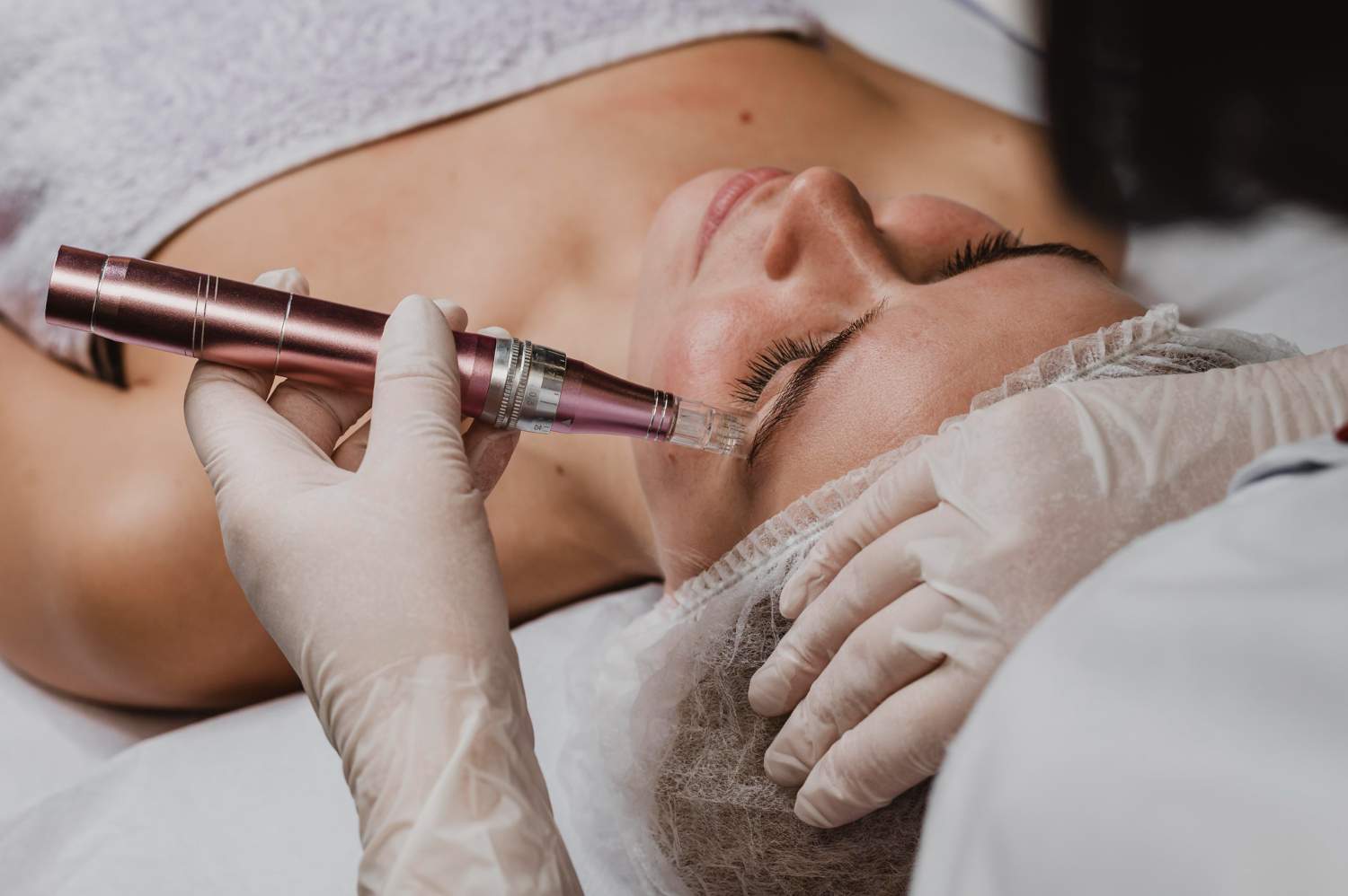 Dermapen facial: qué es, para qué sirve y resultados del microneedling